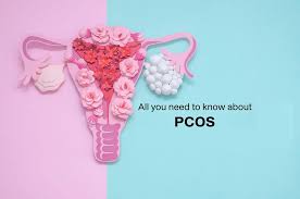 Understanding PCOS: Causes, Symptoms, Prevention, Solutions, and Management